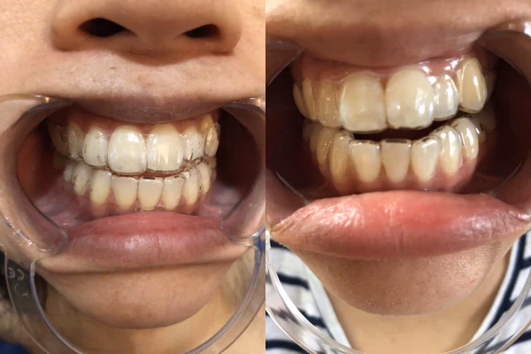 ¿Cómo puedo conseguir dientes de conejo?
