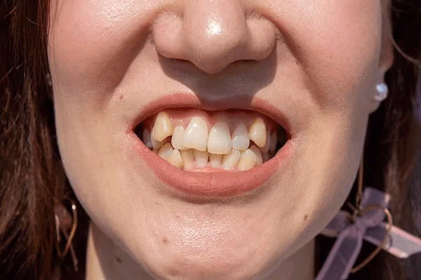 ¿Por qué me salen los dientes de conejo?