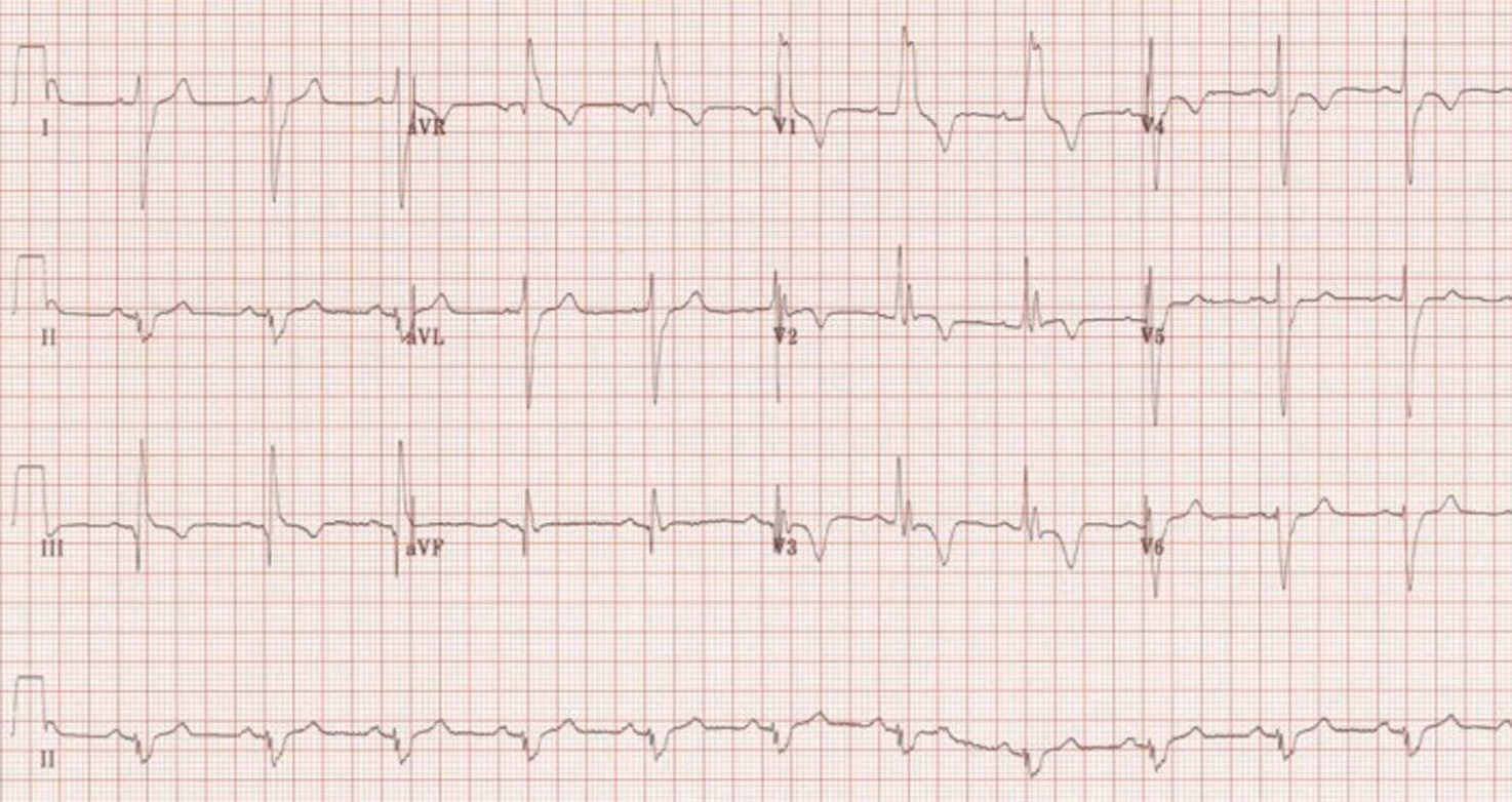 ¿Qué tan grave es un bloqueo de rama derecha?
